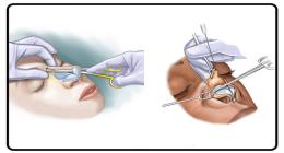 هر آنچه که باید در مورد جراحی و عمل بینی بدانید