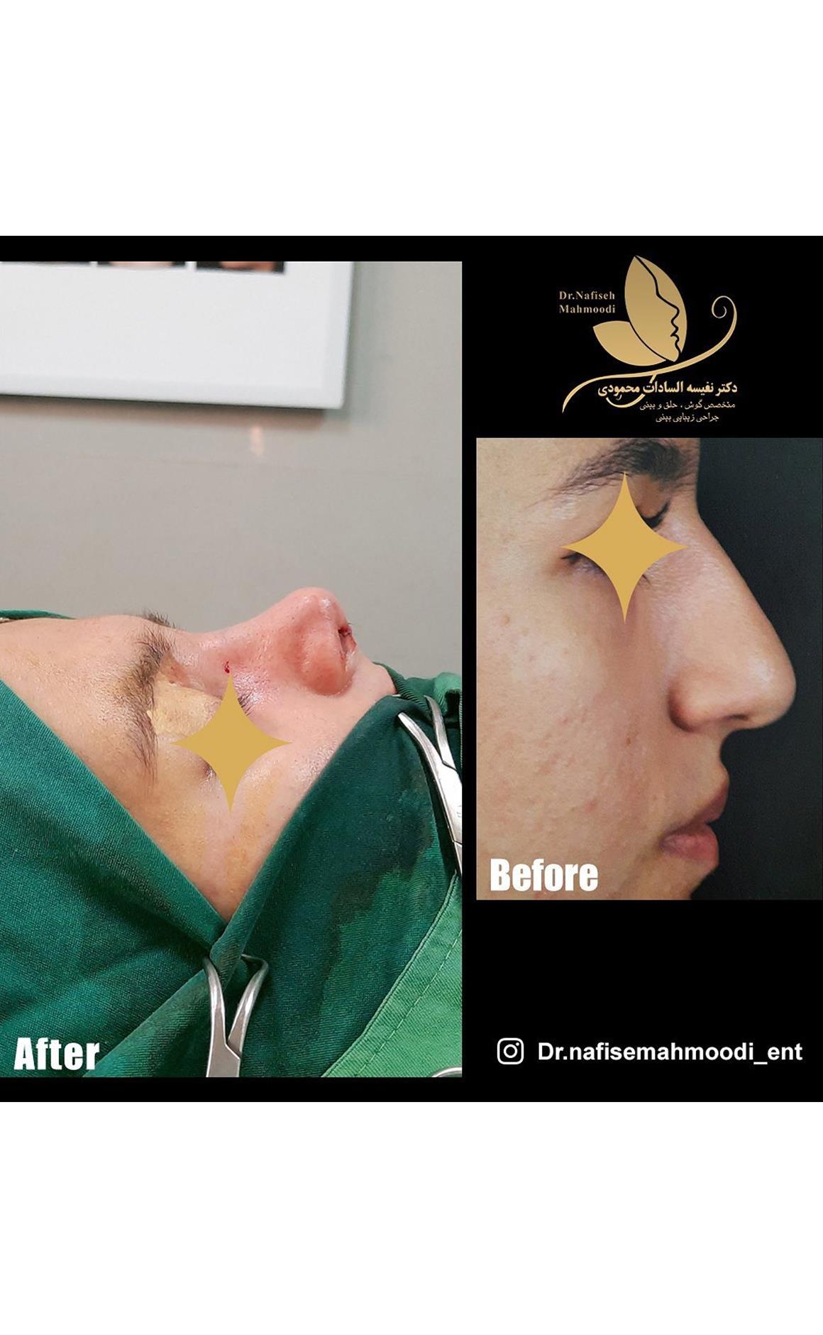 جراحی زیبایی بینی رینو پلاستی در اصفهان توسط دکتر نفیسه سادات محمودی nose reshaping on esfahan