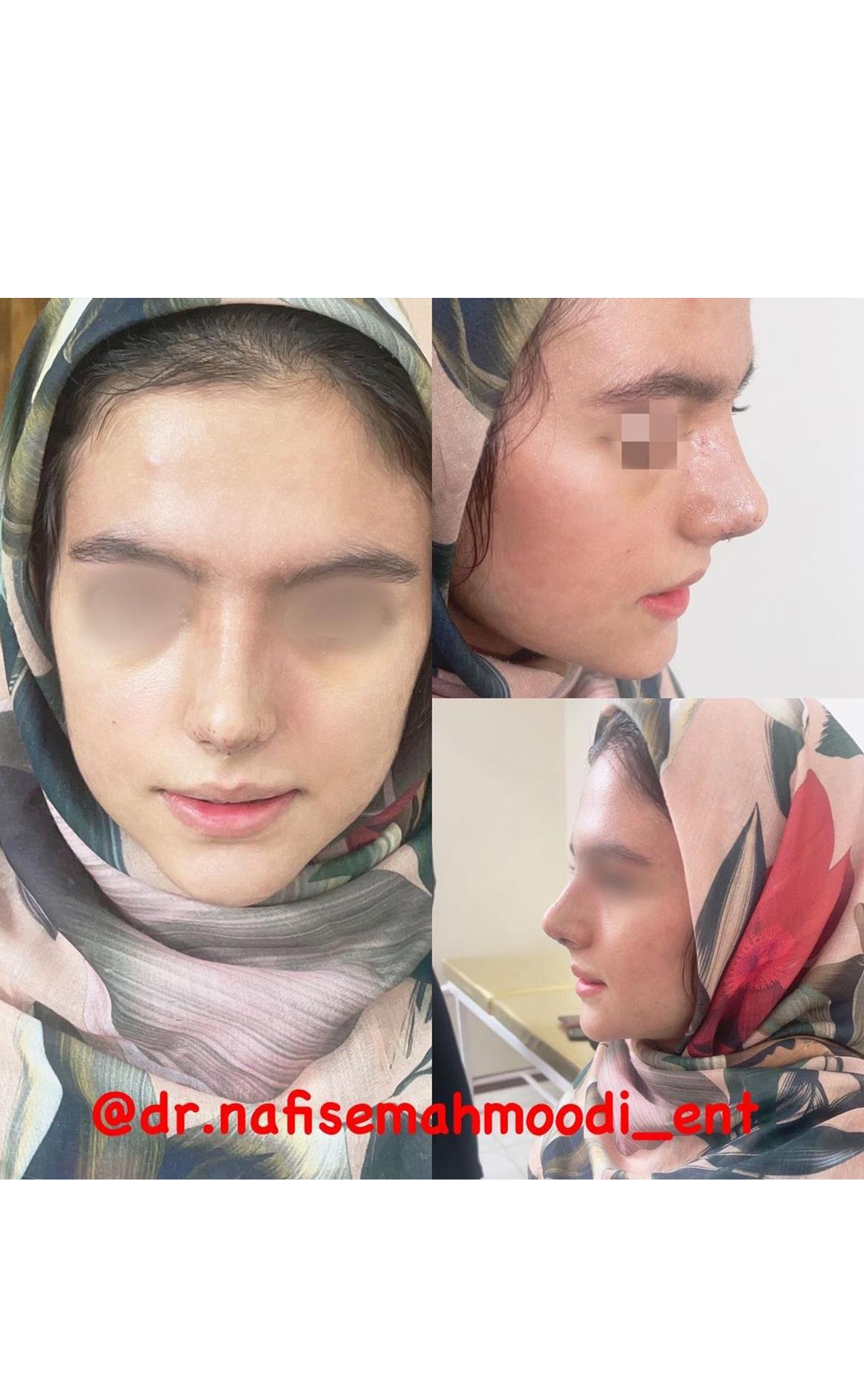 جراحی رینو پلاستی در اصفهان توسط دکتر نفیسه سادات محمودی rhinoplastie on isfahan