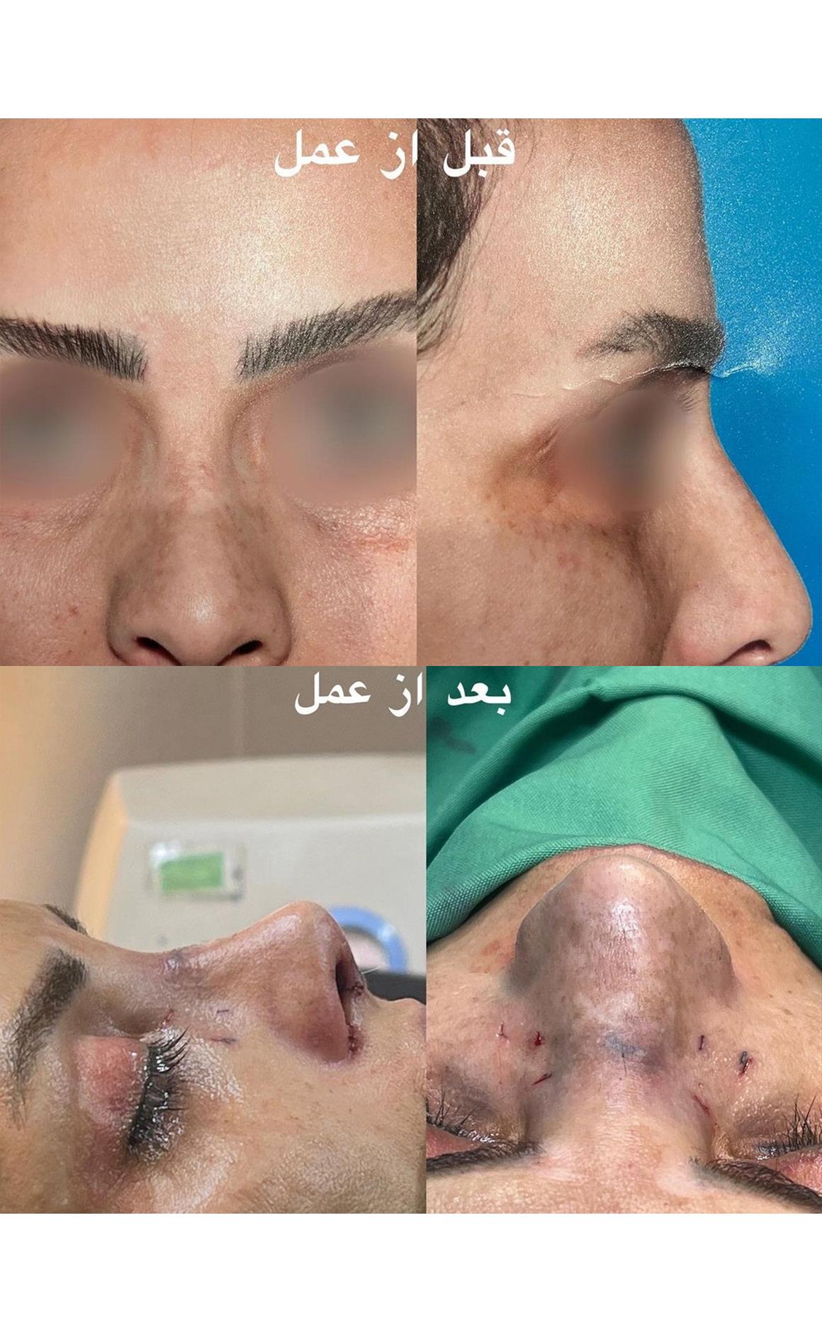 نمونه کار جراحی بینی در اصفهان توسط دکتر نفیسه سادات محمودی